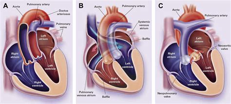 Dextro Transposition Of The Great Arteries Cardiology Clinics