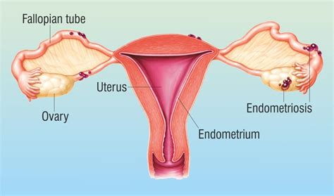 Diagnosis Of Endometriosis Health Talks