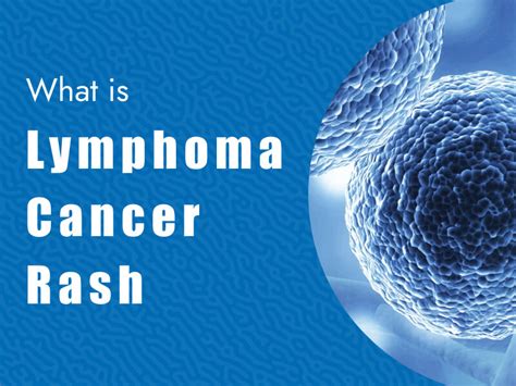 What Is Lymphoma Cancer Rash Massive Bio
