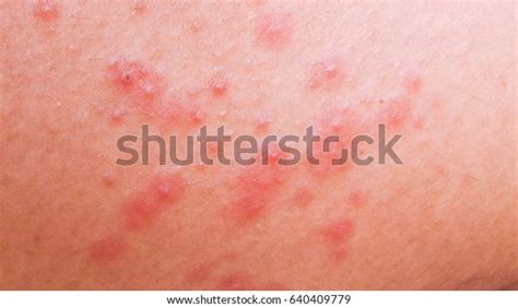 Rash By Allergic Reactions Medicines Stock Photo Edit Now 640409779