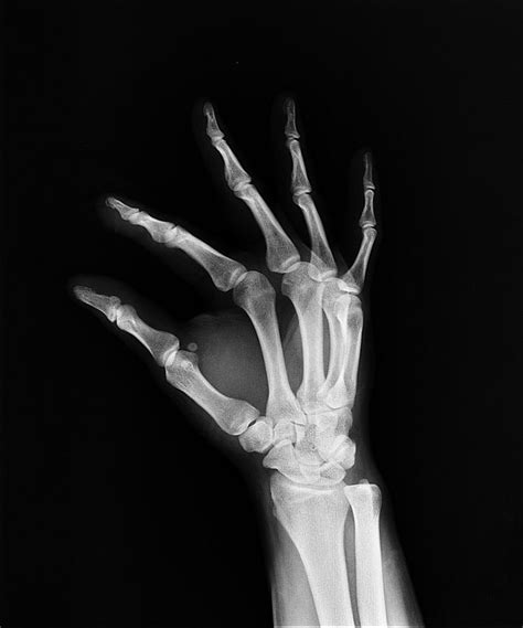 Hand X Ray