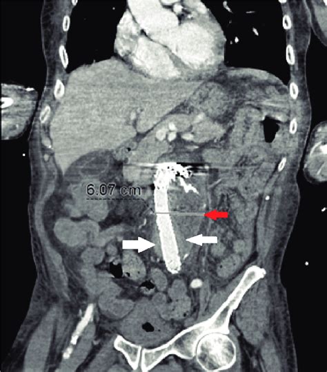 C T Abdomen And Pelvis With IV Contrast Reveals An Approximately 6 Cm