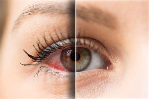 Sindrome Da Occhio Secco Allergie E Fattori Ambientali