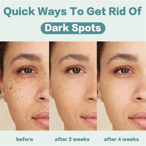 Citygoo Dark Spot Remover For Face And Body Dark Spot Corrector Cream