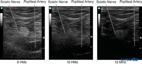 Spatial Resolution Artifact Ultrasound Get Images