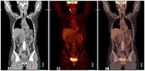 Usefulness Of Petct In The Diagnosis Of Recurrent Or Metastasized