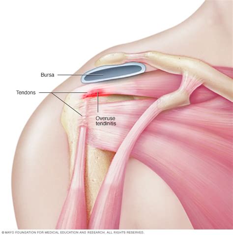 There are 10 muscles and 11 shoulder tendons related to shoulder mobility. Shoulder joint - Mayo Clinic