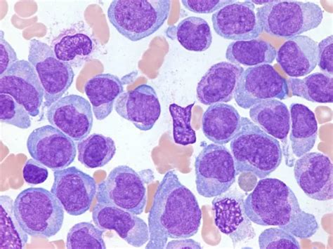 Acute Myeloid Leukemia Aml In Children And Teens Together