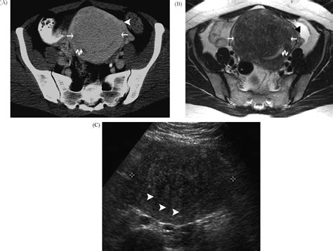 Ct Features Of Adenomyosis European Journal Of Radiology