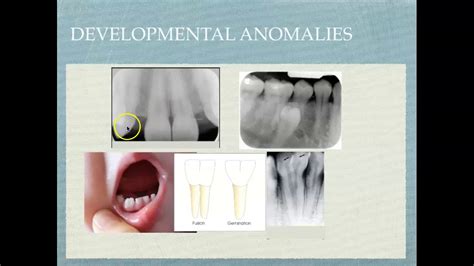 Radiographic Interpretation Of Dental Materials Oral Pathology