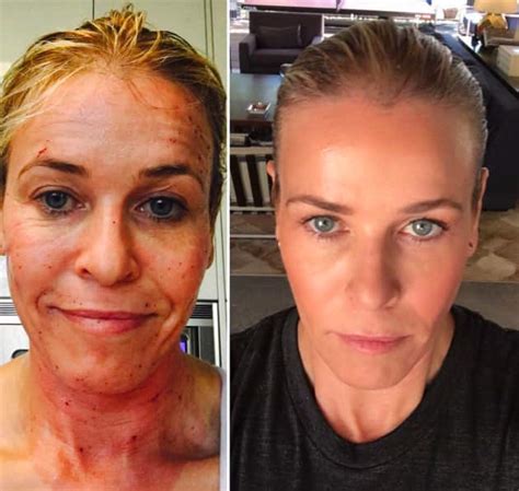 Do you know chelsea handler's age and birthday date? Chelsea Handler Looks Half Her Damn Age After Laser Facial ...
