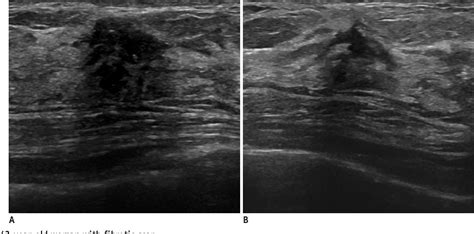 Figure 10 From Are Irregular Hypoechoic Breast Masses On Ultrasound