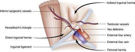 An inguinal hernia is the protrusion of a loop or more of the intestine through a weakened area in the abdominal wall. The abdominal wall and hernia | Basicmedical Key