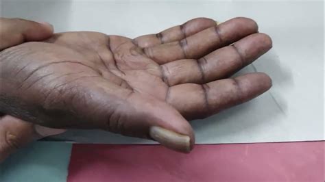 Dupyutrens Contracture Needle Aponeurotomy Youtube