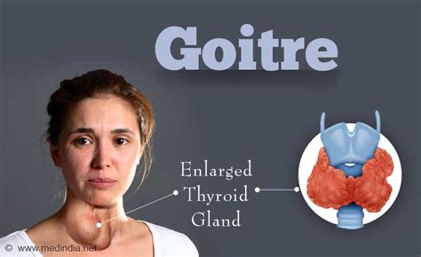 Goitre Symptoms Causes And Home Remedies Saloni