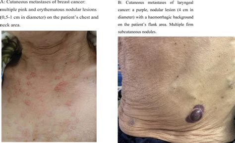 Dermoscopic Findings In Cases Of Cutaneous Metastases