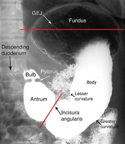 Stomach And Duodenum Radiology Key