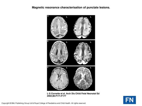 Magnetic Resonance Characterisation Of Punctate Lesions Ppt Download