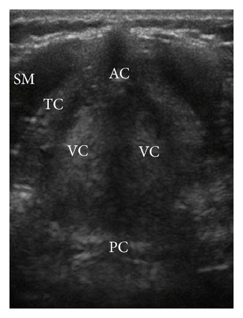 Pulmonary Embolism A Lung Ultrasound Peripheral Triangular And Download Scientific