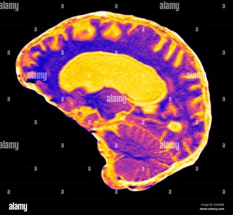 Multiple Sklerose Farbige Magnetresonanztomographie Mrt Scan Eines Sagittalen Vertikal