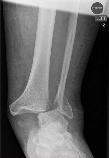 Fractured Ankle X Ray