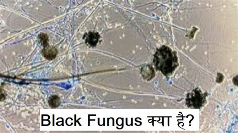 ब्लैक फंगस क्या है जाने संक्रमण के लक्षण और बचाव के उपाय