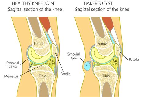How To Treat A Bakers Cyst Chris Bailey Orthopaedics