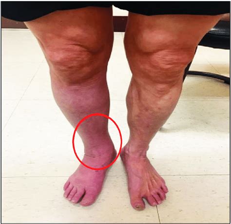 Improvement Of Right Leg Edema Near The Ankle After Management Of The