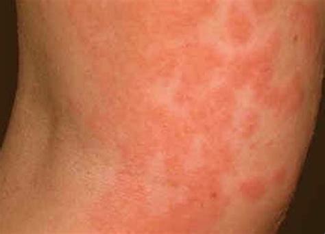 Contact Dermatitis Pictures Symptoms Causes Treatment