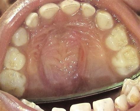 Normal Palate With Healthy Mucosa And Some Signs Of Vacuumpressure