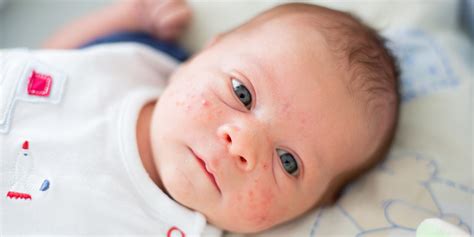 How To Treat Baby Acne Safely According To Pediatricians