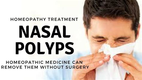 Nasal Polyps Causessymptoms And Homeopathic Treatment In Hindi Youtube