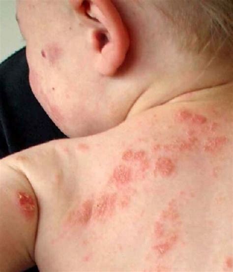 Stress Induced Eczema How Parental Stress Is Hurting Your Kids Dr