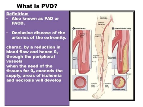 Clinical Examination Peripheral Vascular Disease