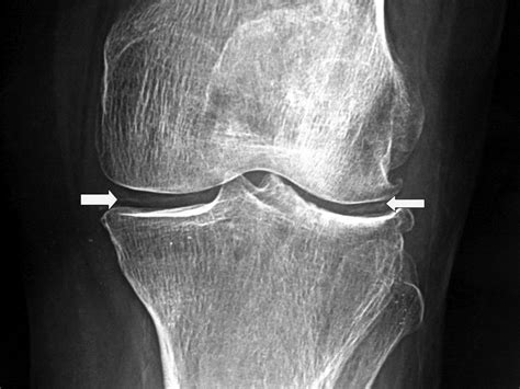 Acute Knee Pain 2016 07 11 Ahc Media Continuing Medical