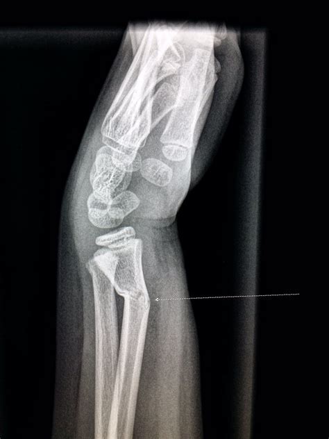 X Ray Of A Boys Wrist Showing A Buckle Fracture