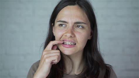 The Girl Wears Braces On Her Teeth Discomfort Pain Stock Video