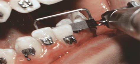 Everything You Need To Know About Tooth Stripping In One Place Dental Supplies And Equipment