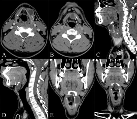 A Axial Contrast Enhanced Ct Scans Of The Neck Show A Open I