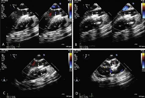 Percutaneous Perventricular Device Closure Of Ventricular Septal Defect