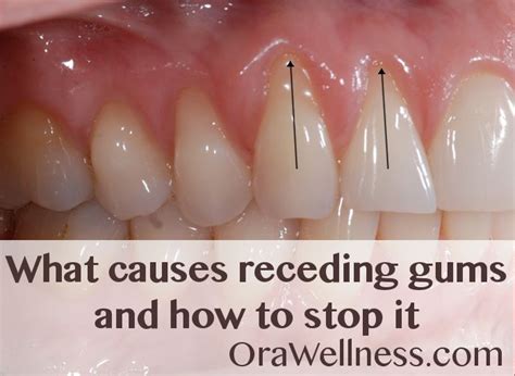 What Causes Receding Gums And How To Stop It Orawellness Gum Health