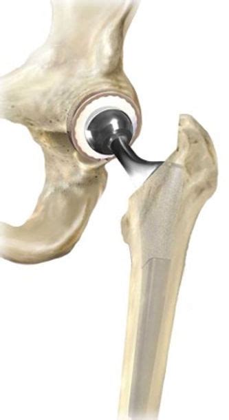 Hip Replacement Incision Palm Bay Fl Orthopedic Center