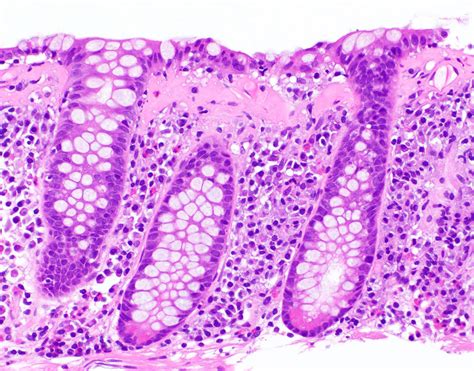 Pathology Outlines Collagenous Colitis