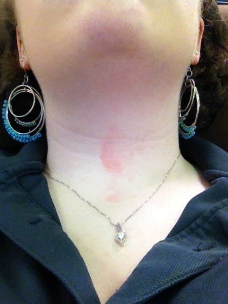 Mysterious Red Mark On My Neck Wtf Beautylish