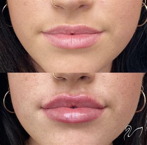 Restylane Lyft Lips Before And After