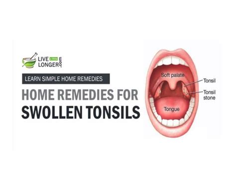 Ppt Home Remedies For Swollen Tonsils Powerpoint Presentation Free