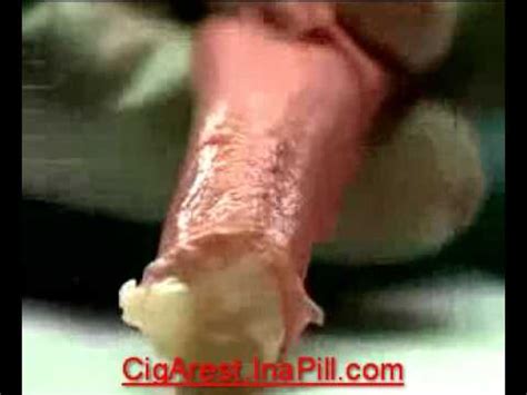 We did not find results for: Stop Smoking Artery Damage - YouTube