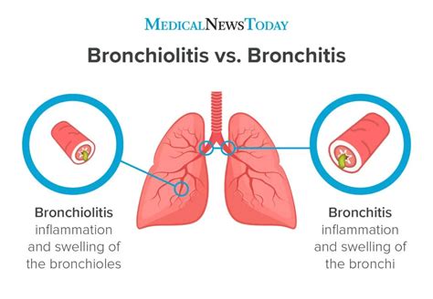 Bronchitis Symptoms Causes And Treatments For Malaysians