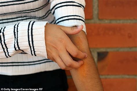 Australias La Niña Causes Rise Of Eczema Cases As Humid Weather