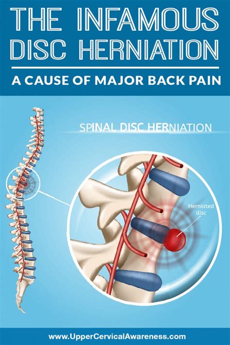 The Infamous Disc Herniation A Cause Of Major Back Pain
